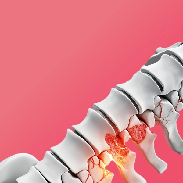 Osteoporosis category image