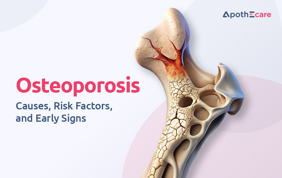 Osteoporosis: Causes, Risk Factors, and Early Signs
